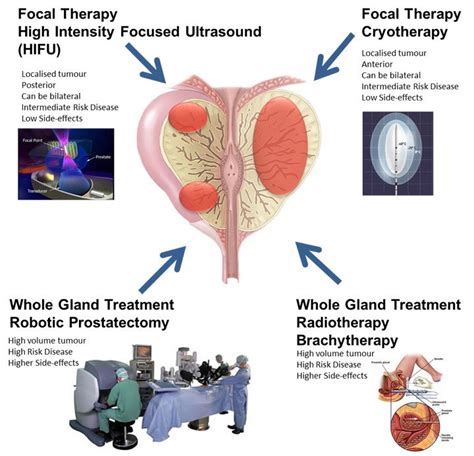 what is the givenchy prostate procedure|pinnacle prostate treatment.